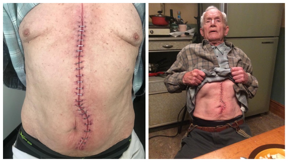 Falling — surgical scar prosthetic reference