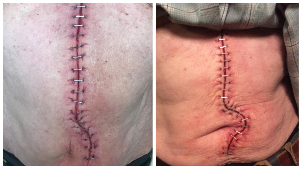 Falling — surgical scar prosthetic detail